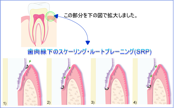 歯周病の治療プロセス